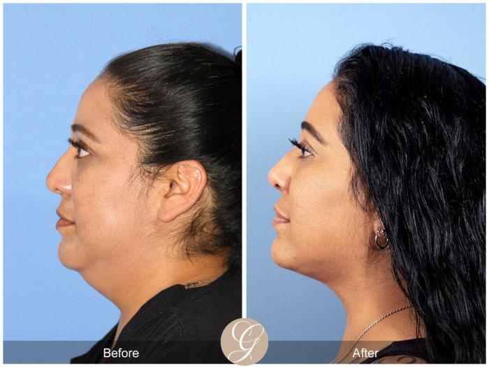 Liposuction Options