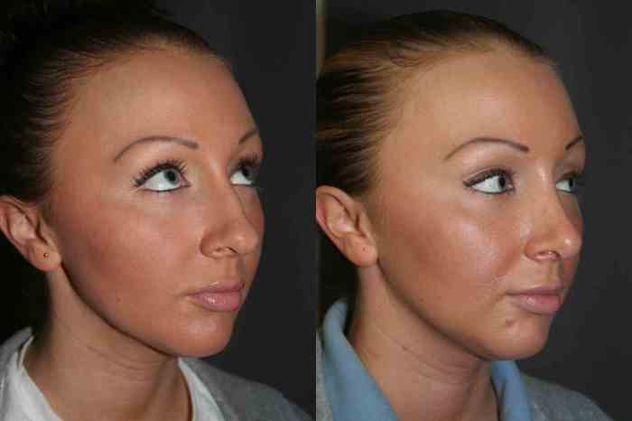 Rhinoplasty Before and After
