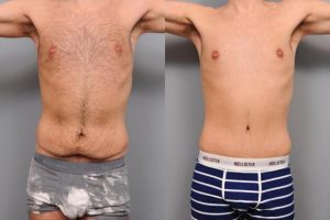 Tummy tuck surgery plastic