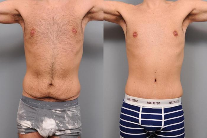 Tummy tuck surgery plastic