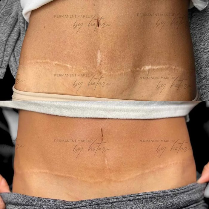 Tuck tummy effects benefits surgeon